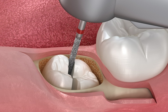 Surgical Tooth Extraction By Mr and Mrs Dentist